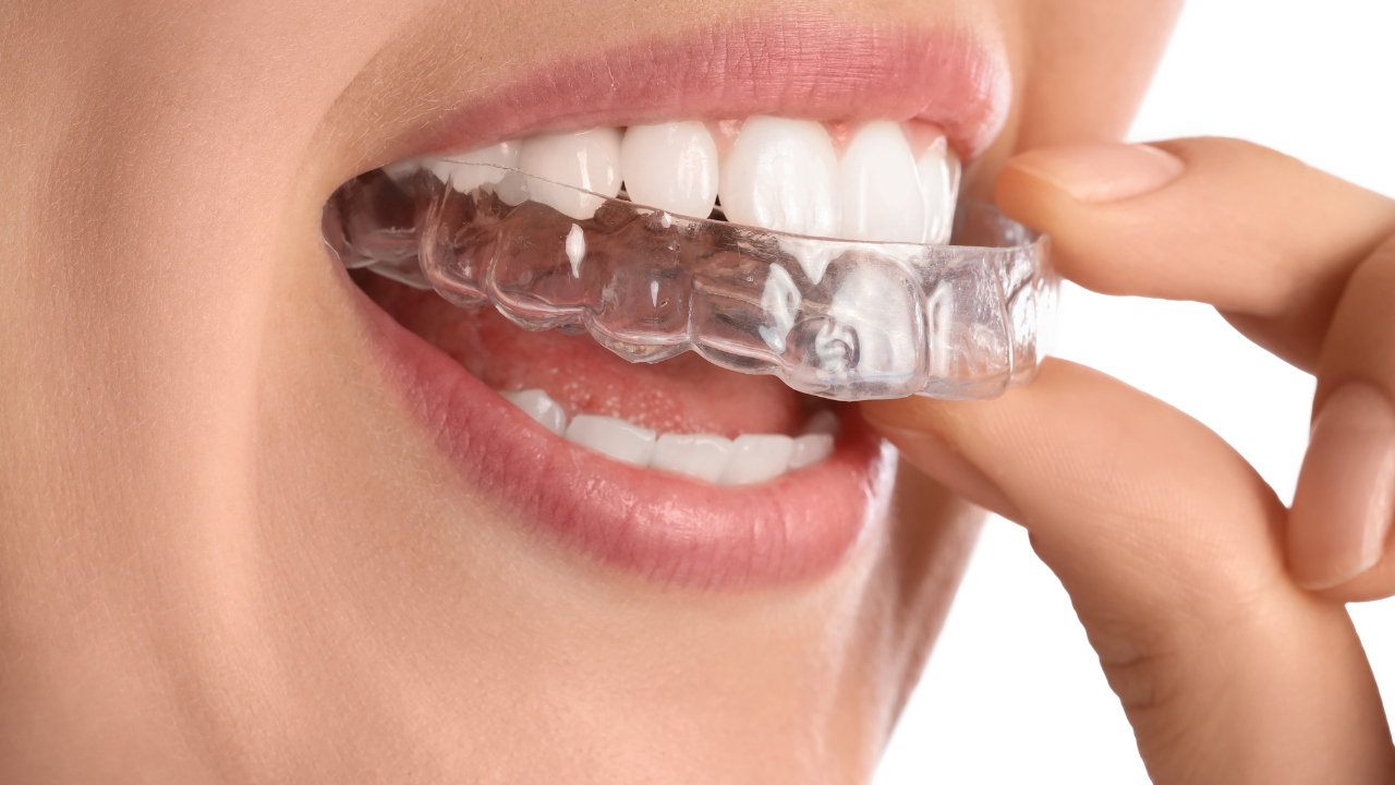 Surprising Ways Modern Aligners Have Changed In India 2026