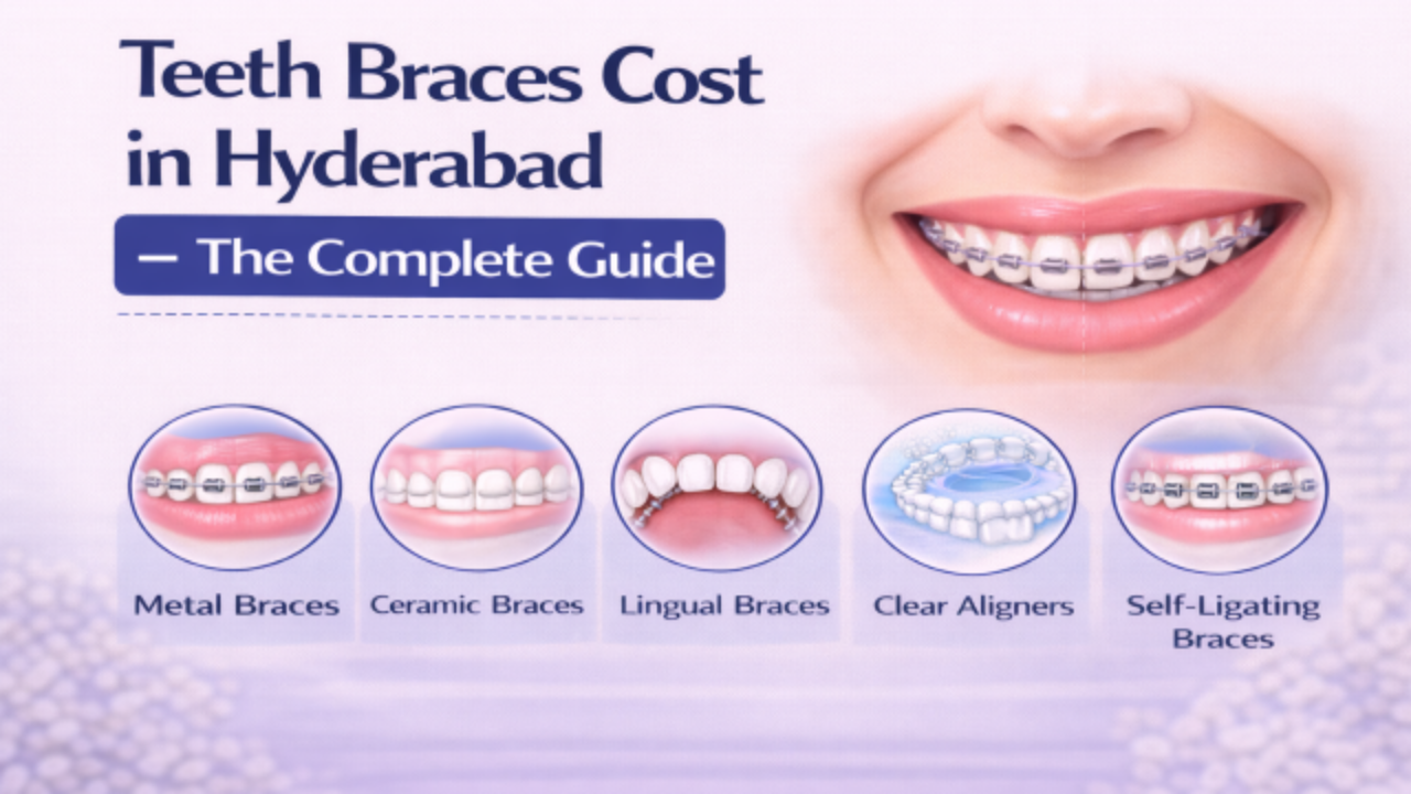 Teeth Braces Cost in Hyderabad - The Complete Guide