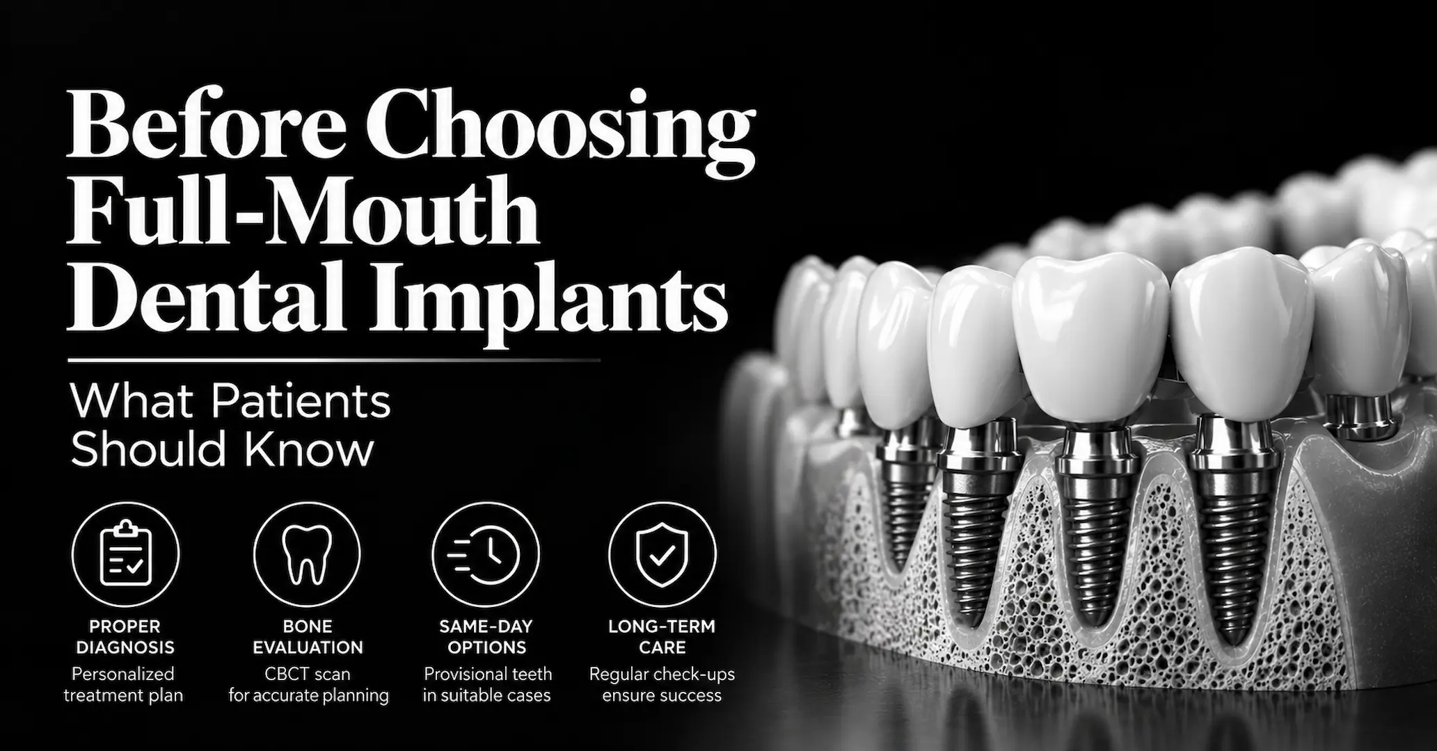 Full-Mouth Implant Guide